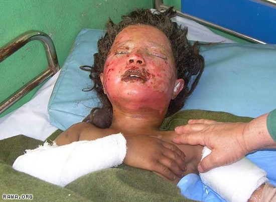 Injured girl in Farah.