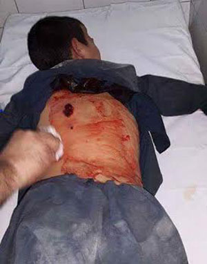 A child wounded by the shots fired by the Shorae Nezar men